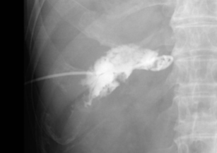 経皮経肝胆嚢ドレナージ術(PTGBD)