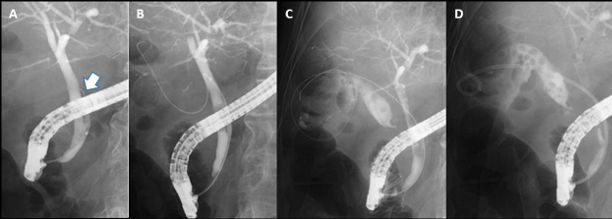 内視鏡的胆嚢ドレナージ（EGD）