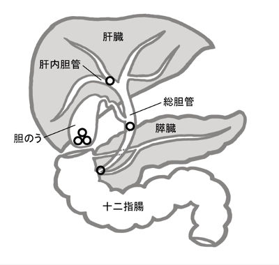 胆石（たんせき）とは