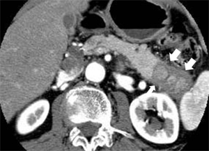 図1　自己免疫性膵炎のCT所見：膵臓の尾部（矢印）が腫れています