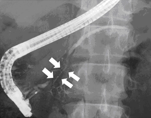 図2　自己免疫性膵炎の膵管造影所見：矢印で示す部分の膵管が不整に細くなっています