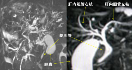 図1：原発性硬化性胆管炎の胆管像（MRI）左が原発性硬化性胆管炎症例の胆管。右の正常例と比較して肝内胆管は高度に狭窄、分断されていることが分かります。