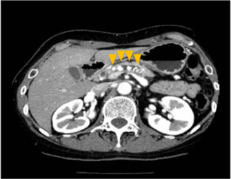 慢性膵炎のCT画像
