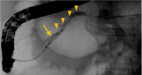 内視鏡による膵石の除去