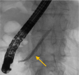 内視鏡による膵管ステントの留置