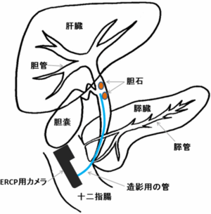 内視鏡的逆行性胆道膵管造影とは