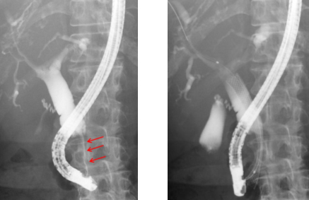 内視鏡による金属ステント留置術